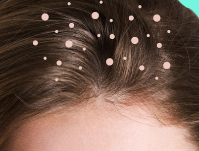 How to Get Rid of Itchy Scalp, Causes and Remedies
